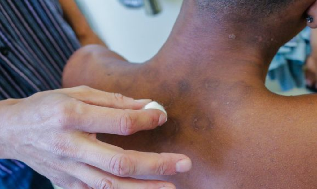 B88e052c Hanseniase 1024x613