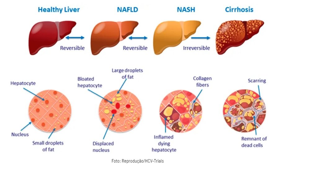 Gordura no fígado: ácido úrico e frutose altos podem desencadear esteatose hepática não alcoólica Dfee452e 1
