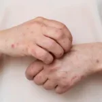 varicela