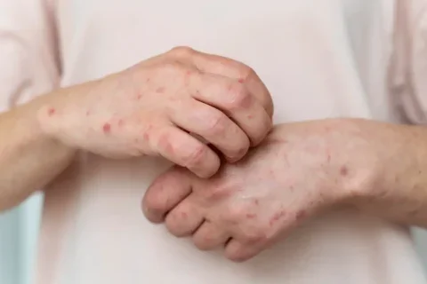varicela